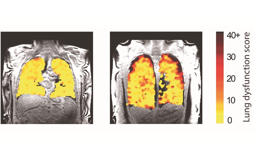 Imagen: RM de la función pulmonar que muestra mediciones en un receptor de trasplante de pulmón (foto cortesía de la Universidad de Newcastle)